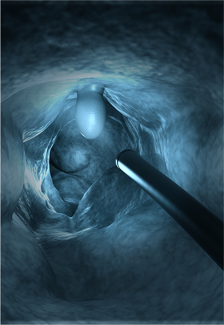 Colonoscopy